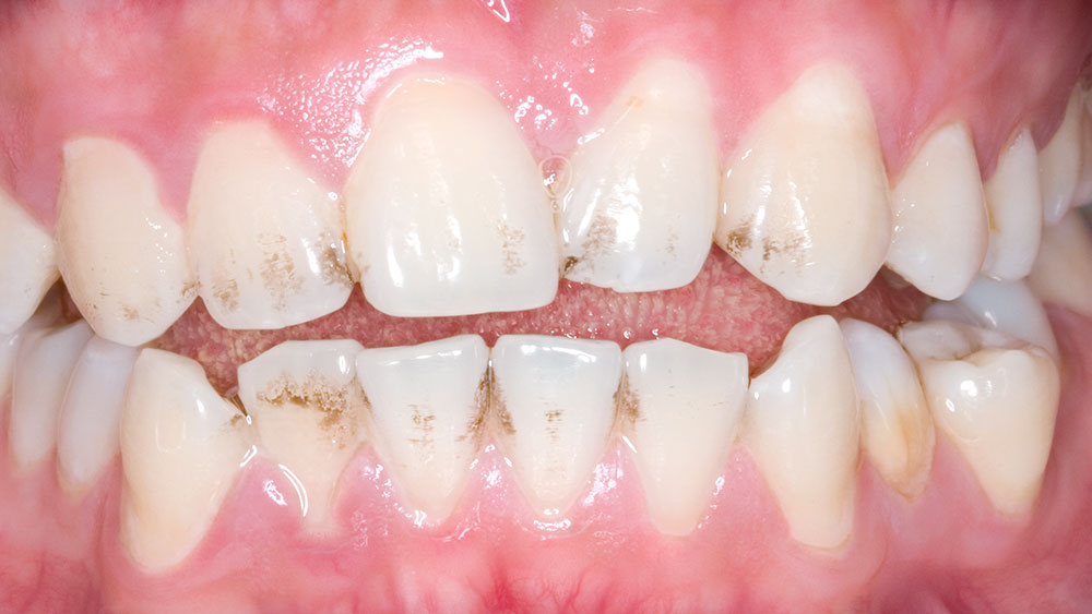 Prismatik Clinical Zirconia Case Image before