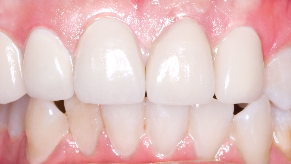 Prismatik Clinical Zirconia Case Image After